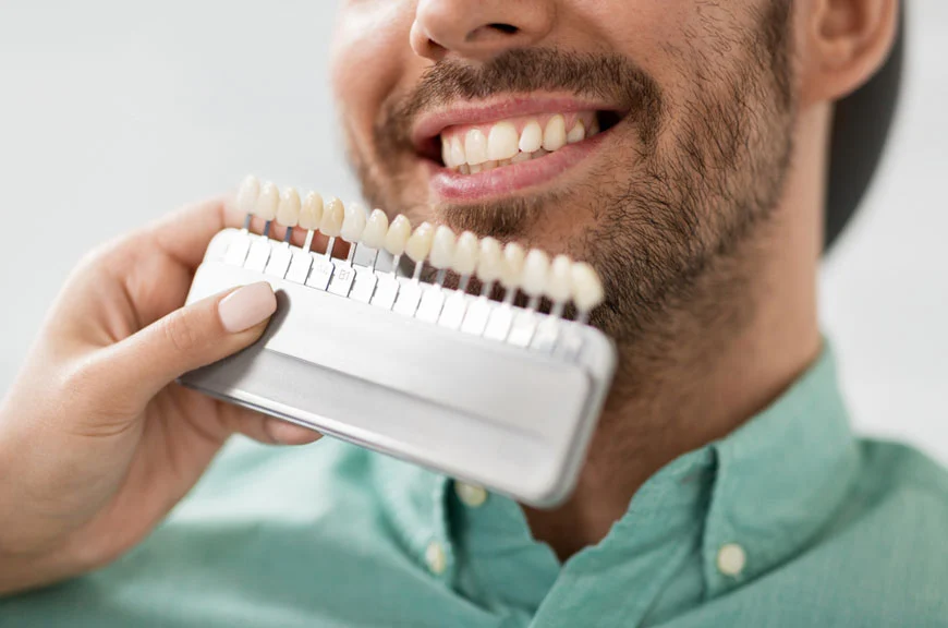 porcelain-veneer